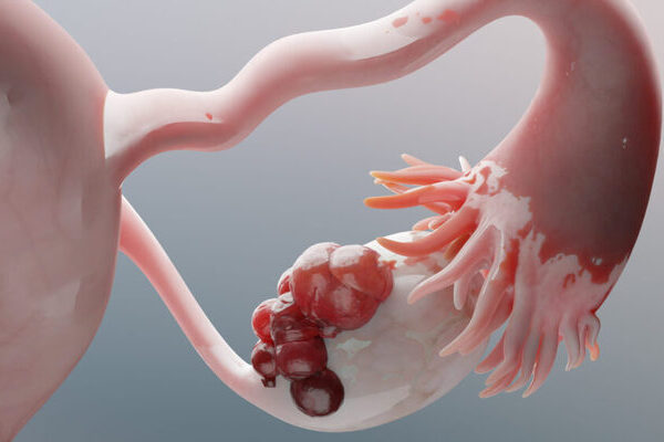 Descubren una combinación de terapias para el tratamiento del cáncer de ovario