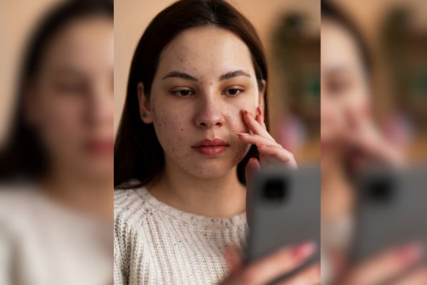 Acné adulto: La «epidemia silenciosa» que afecta al 35% de la población femenina